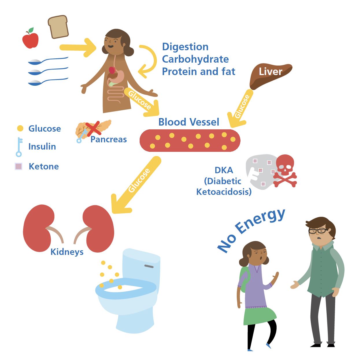GNL keystone diagram showing immune cells attacking the insulin-producing beta cells of the pancreas in type 1 diabetes.