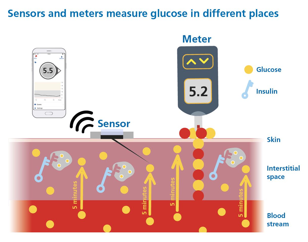 Diagram comparing finger-prick blood glucose measurement with CGM interstitial glucose measurement, showing a time lag between the two.