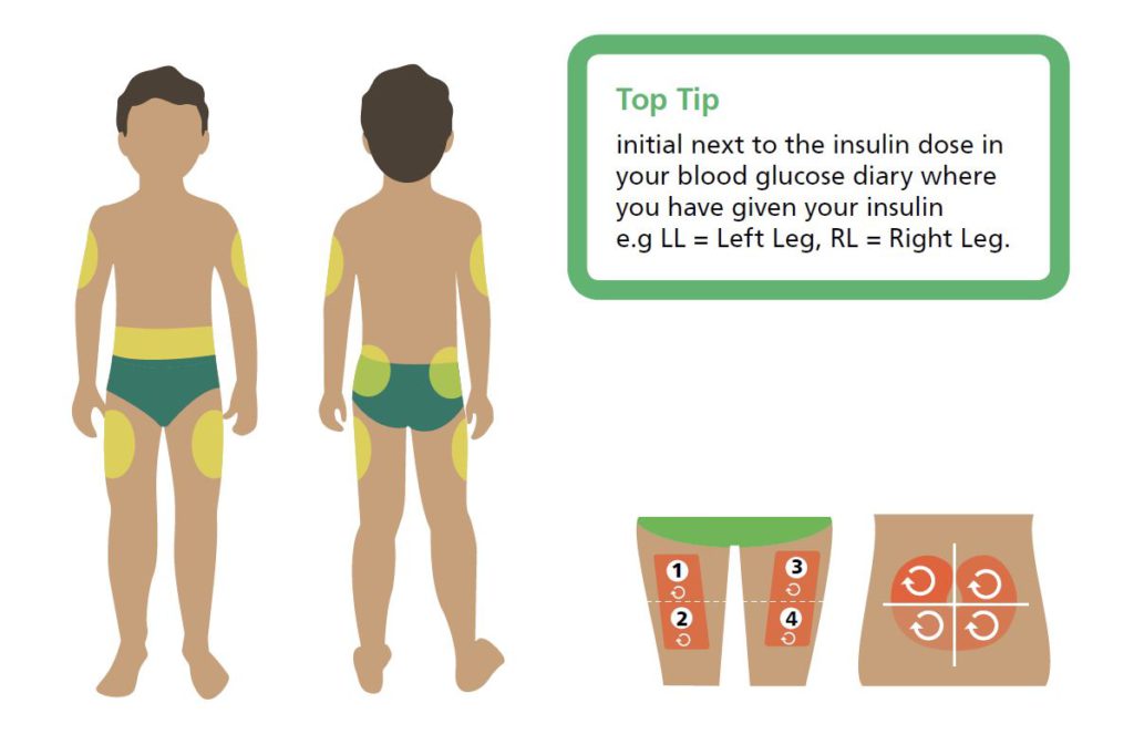 Injection site rotation map showing how to cycle between body locations to reduce the risk of lipohypertrophy.
