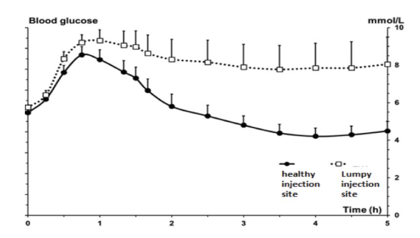 Photo illustration of lipohypertrophy — lumpy injection sites where insulin absorption becomes slow and unreliable.